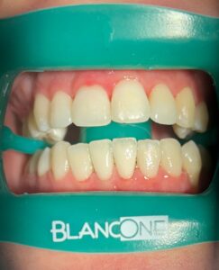 Igiene Dentale 6 Igiene Dentale