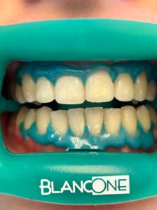 Igiene Dentale 5 Igiene Dentale