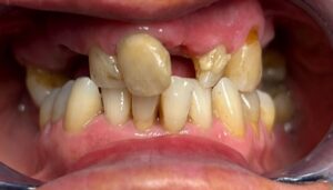 Implantologia Carico immediato 4 Implantologia Carico immediato