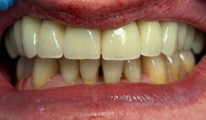 Implantologia Carico immediato 5 Implantologia Carico immediato