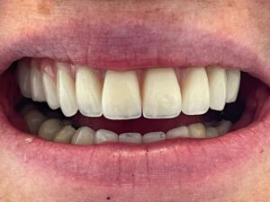 Implantologia Carico immediato 7 Implantologia Carico immediato