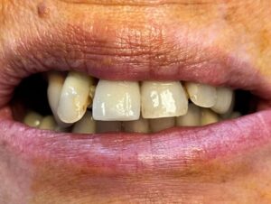 Implantologia Carico immediato 6 Implantologia Carico immediato